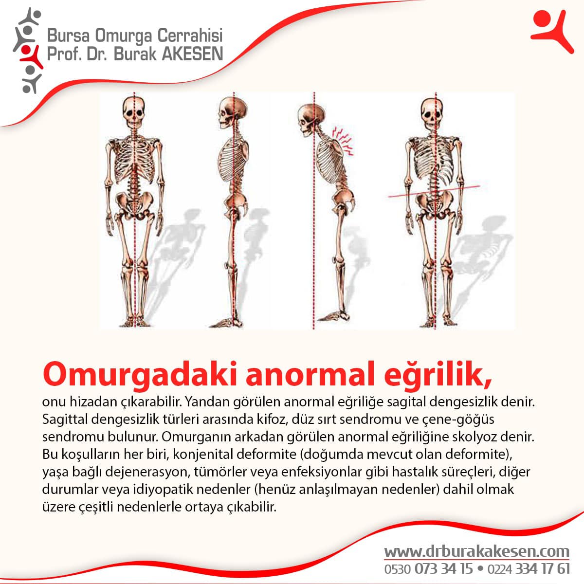 Omurgadaki anormal eğrilik